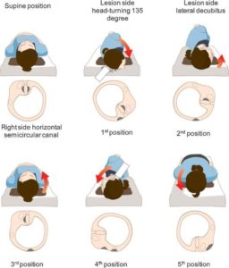 Horizontal Canal BPPV - Vestibular First