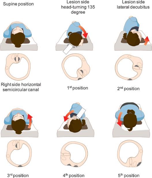 Kim Maneuver (Cupulith Repositioning Maneuver) for Horizontal Canal Cupulolithiasis by Kim et al., 2012