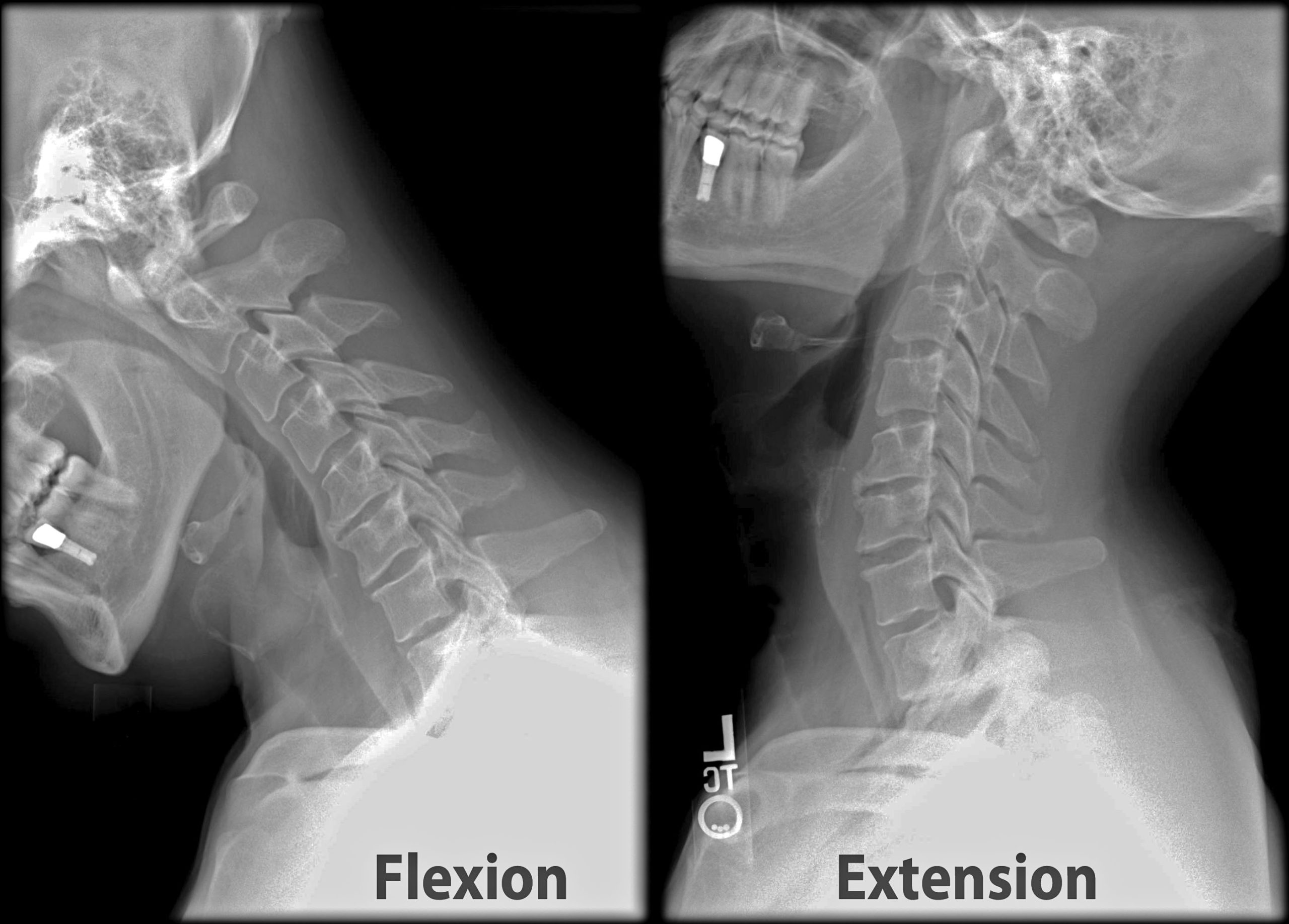 Neck Flexion and Extension