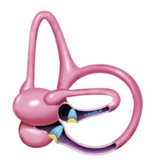 A-044 BPPV Horzontal Canal Canalithiasis (1)