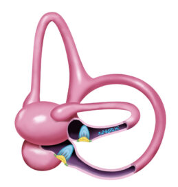 A-044 BPPV Horzontal Canal Canalithiasis (1)