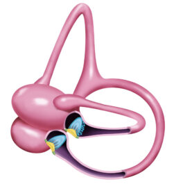 A-045 Horzontal Canal Cupulolithiasis (1)