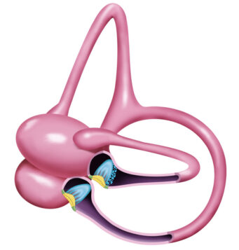 A-045 Horzontal Canal Cupulolithiasis (1)