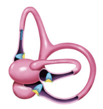 BPPV Anterior Canal