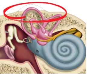 Superior Semicircular Canal Dehiscence (SSCD) | Vestibular First