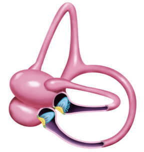 A-045 Horzontal Canal Cupulolithiasis (2)