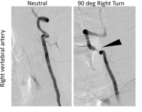 Dynamic DSA demonstrating position-dependent vertebral artery stenosis with rightward head rotation in Bow Hunter syndrome.  Adapted from Schubert MC, Carter N, Lo SL. Front Neurol. 2021;12:814998. CC BY 4.0.